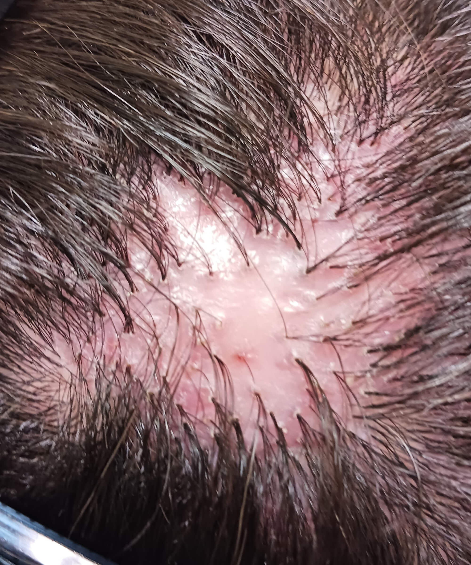 瘢痕性脱毛症 強拡大