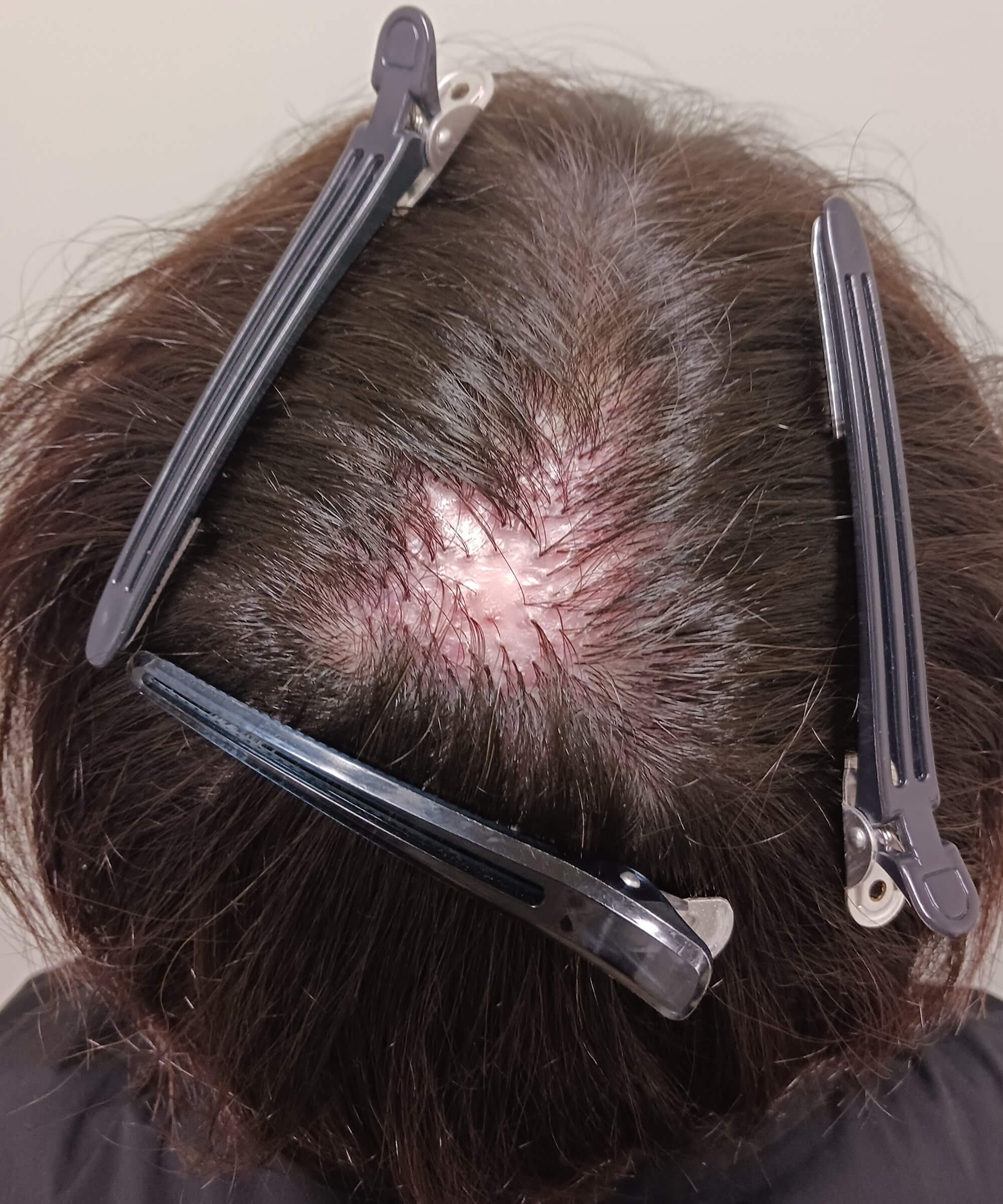 瘢痕性脱毛症 弱拡大