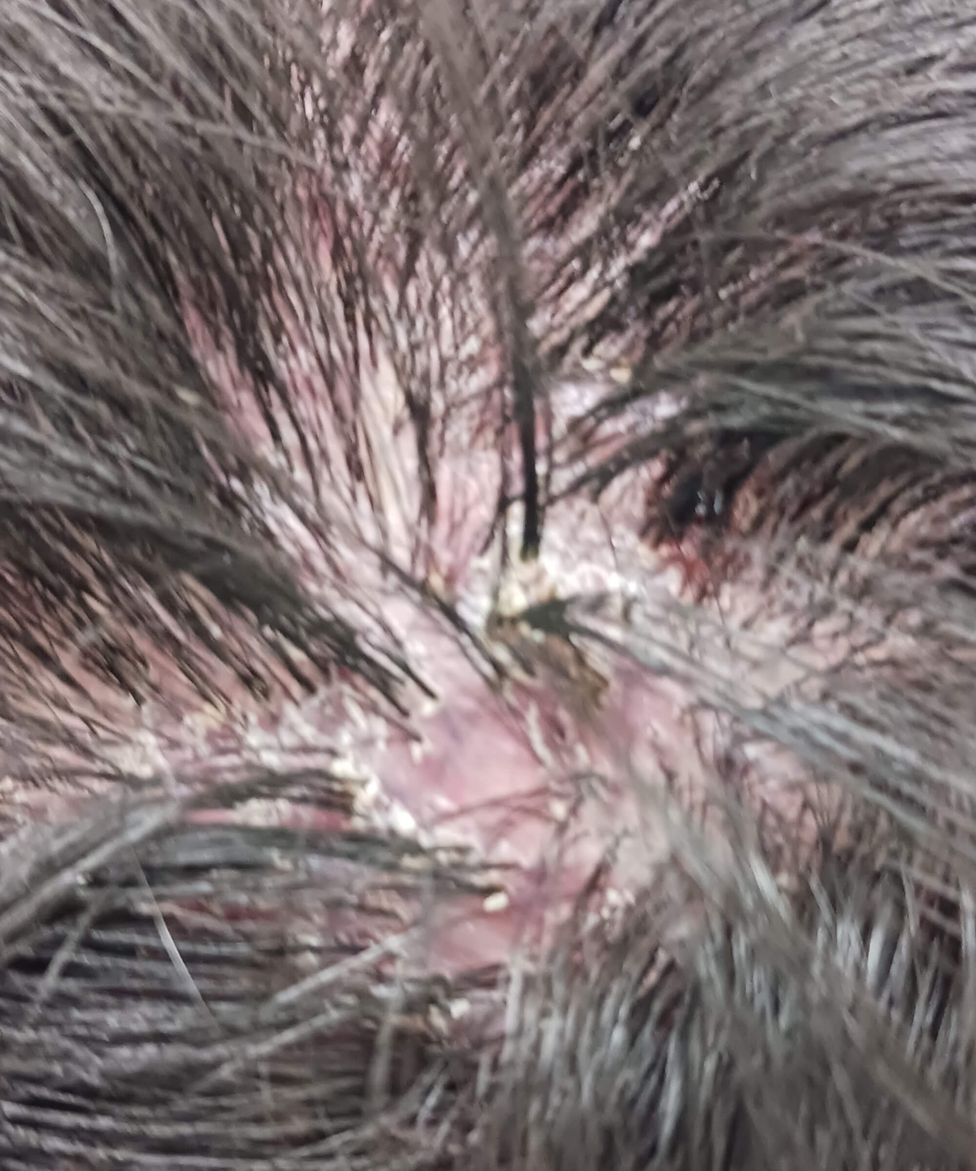 瘢痕性脱毛症 症例2 拡大