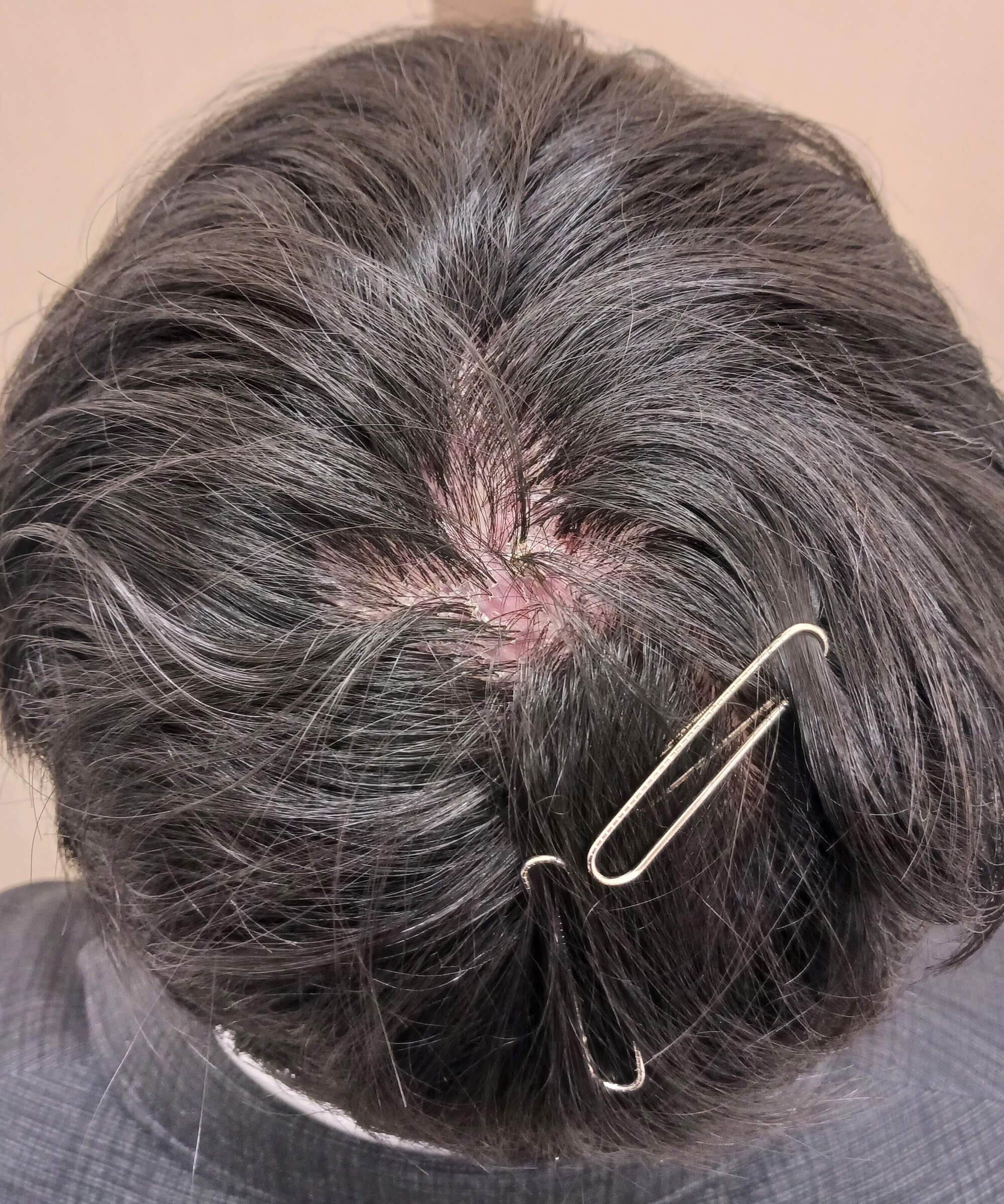 瘢痕性脱毛症 症例2 通常