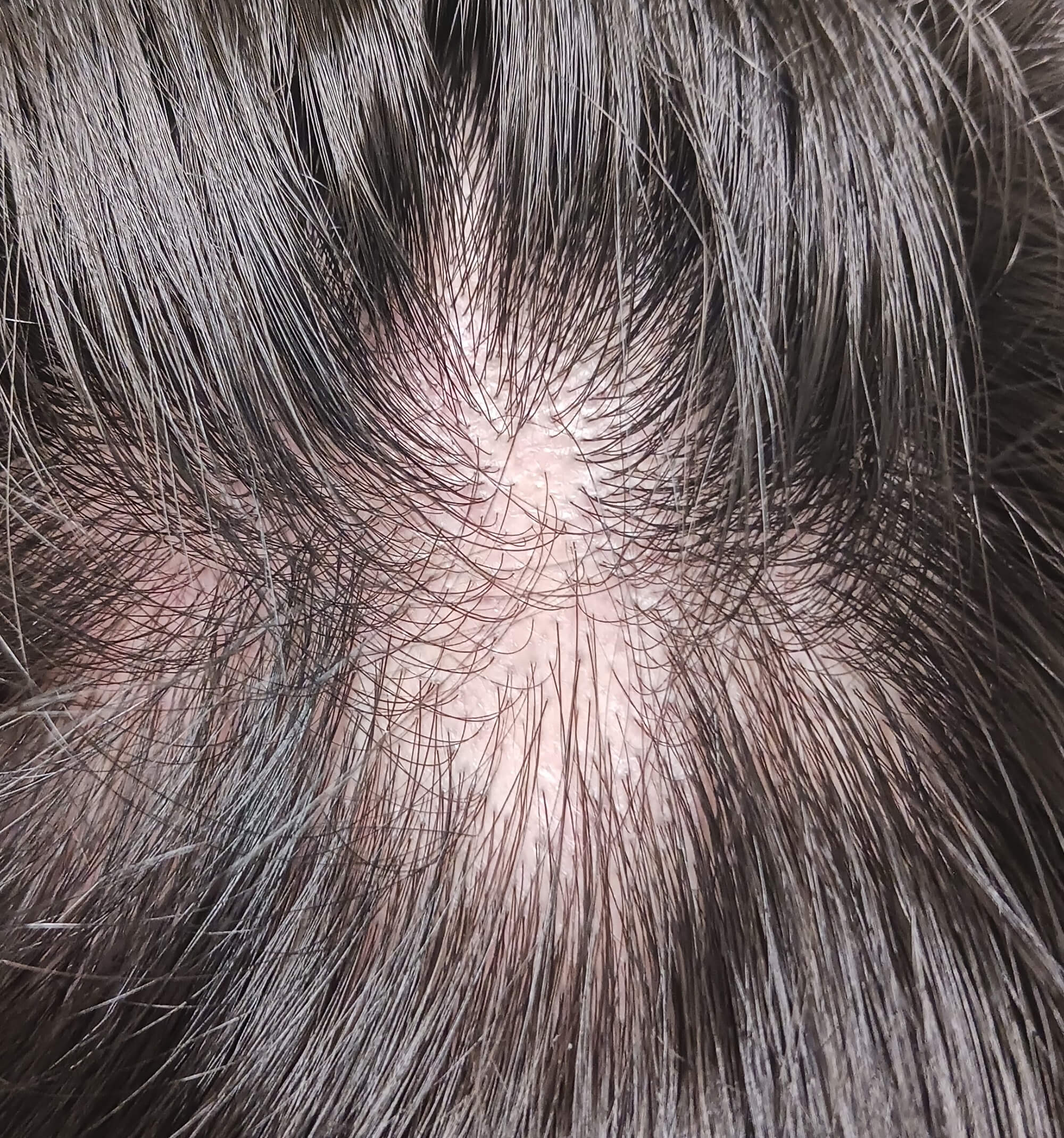 毛孔性扁平苔癬 拡大