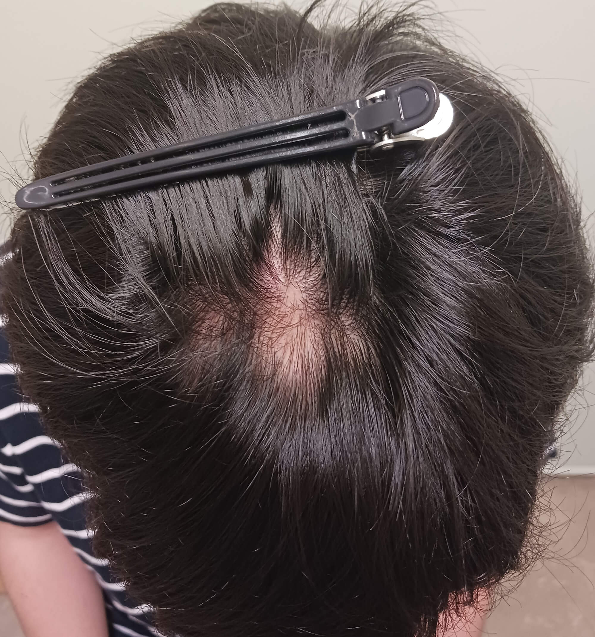 毛孔性扁平苔癬 通常