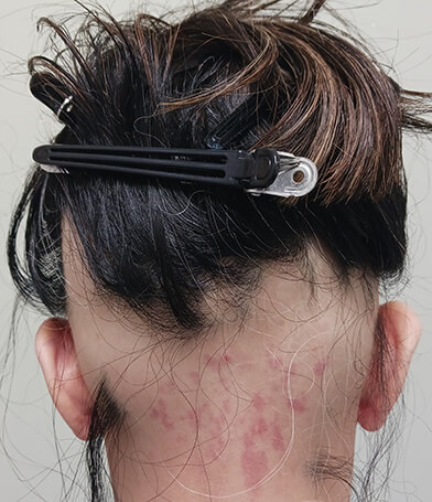 蛇行型脱毛症 後方