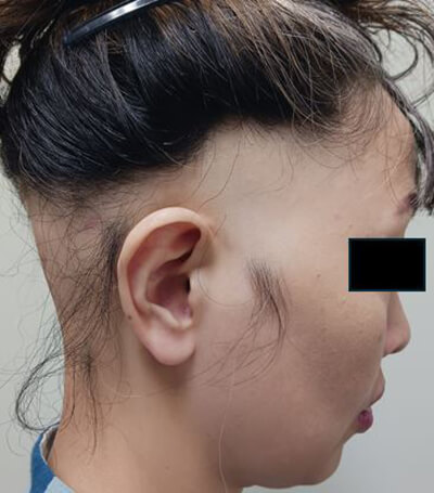 蛇行型脱毛症 右側面