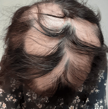 小児女児・多発性脱毛症 BEFORE