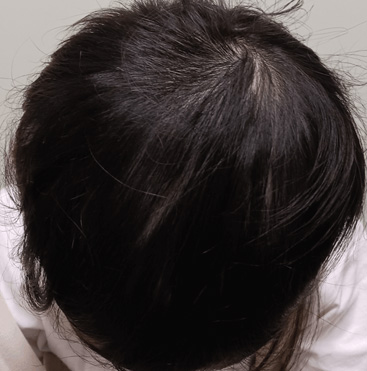 小児女児・多発性脱毛症 AFTER