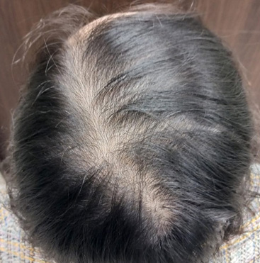 女性薄毛 FPHL BEFORE