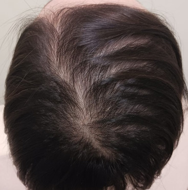 女性薄毛 FPHL AFTER