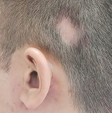 男性・円形脱毛症 BEFORE