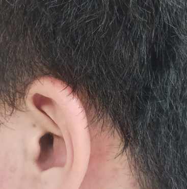 男性・円形脱毛症 AFTER