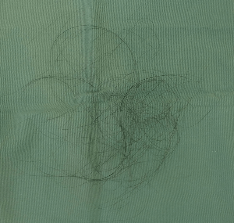 10才の女の子-抜け毛