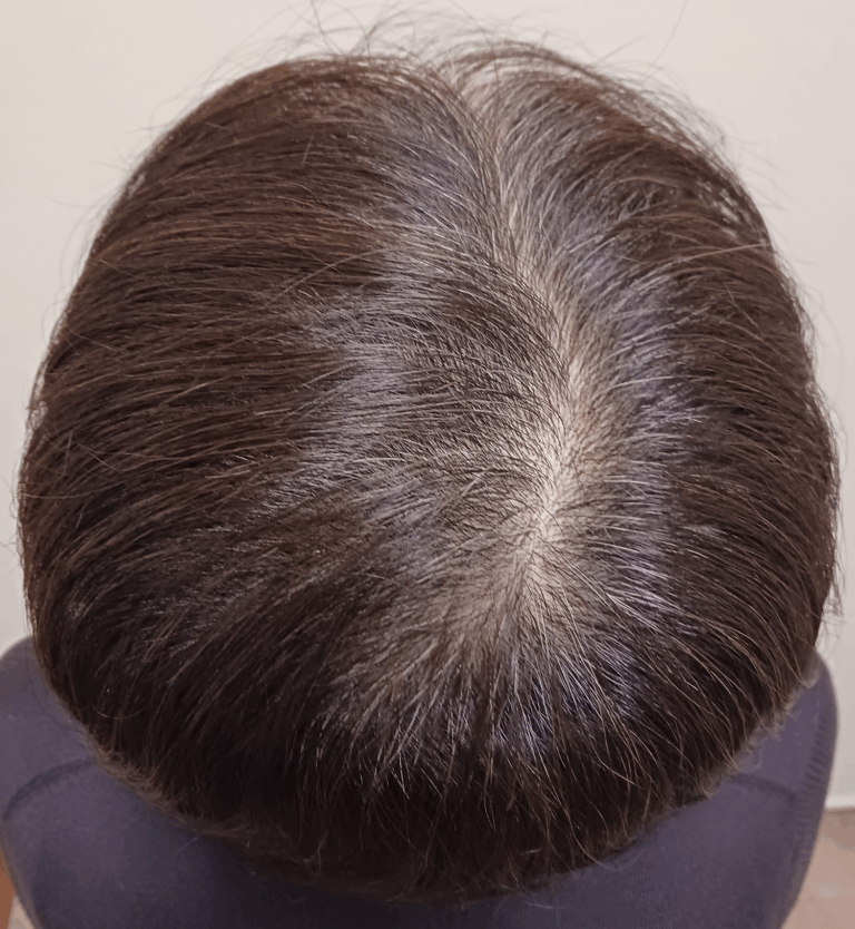 50代女性-初診時-頭頂部