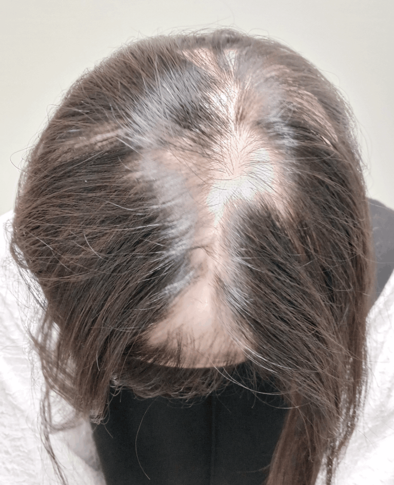 円形脱毛症-女性