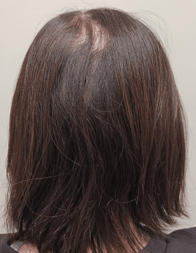 円形脱毛症-女性