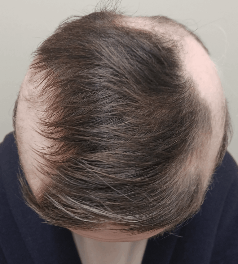 円形脱毛症-女性