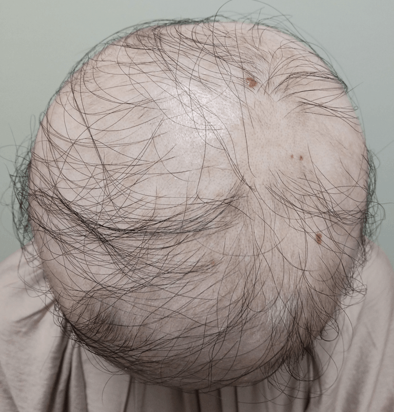 円形脱毛症-女性