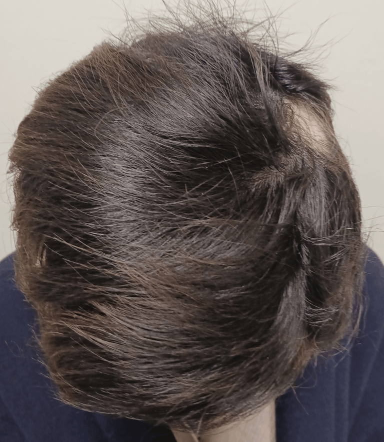 円形脱毛症-女性