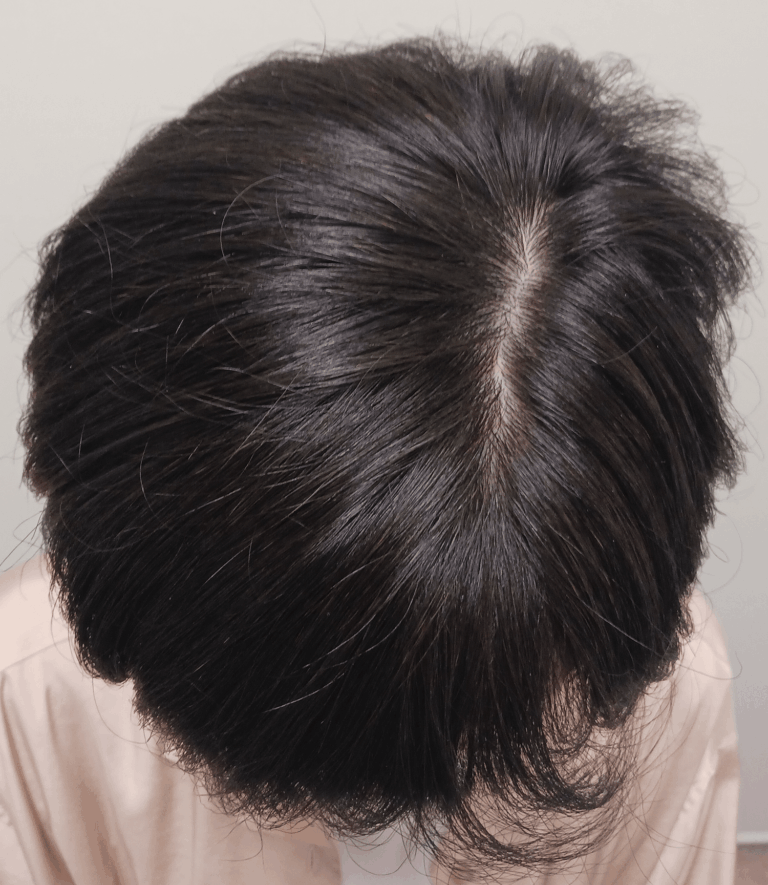 円形脱毛症-女性