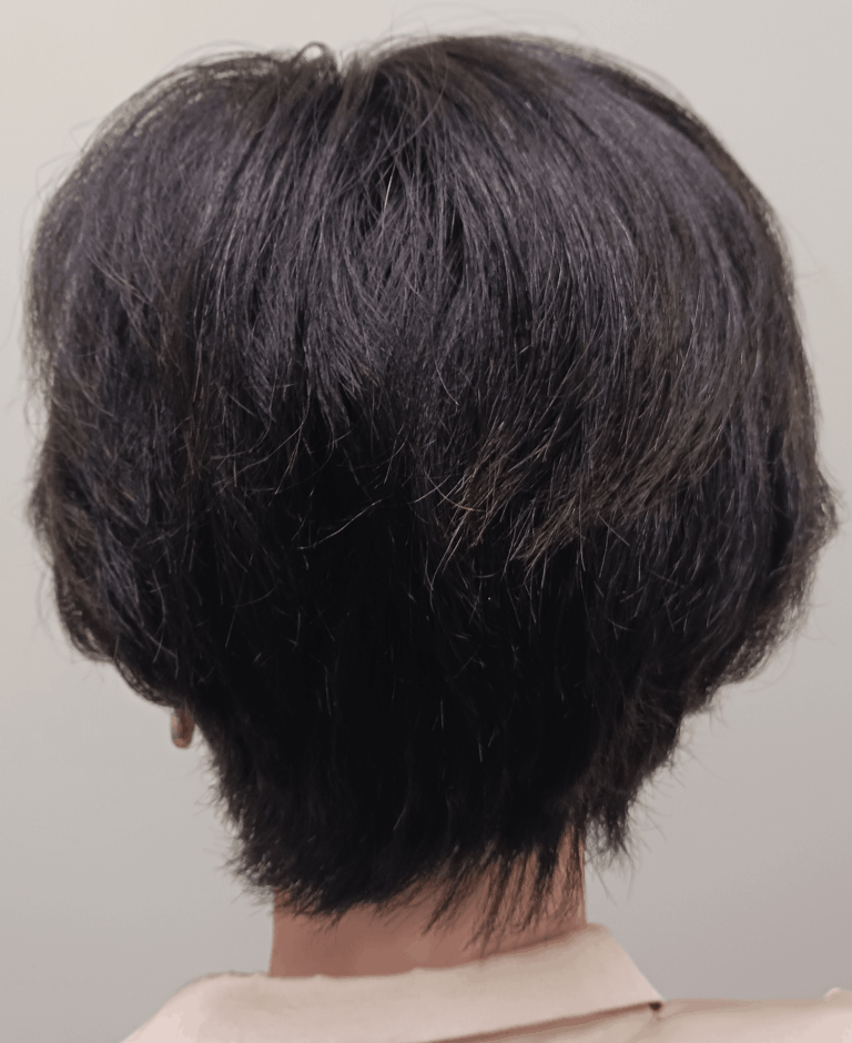 円形脱毛症-女性